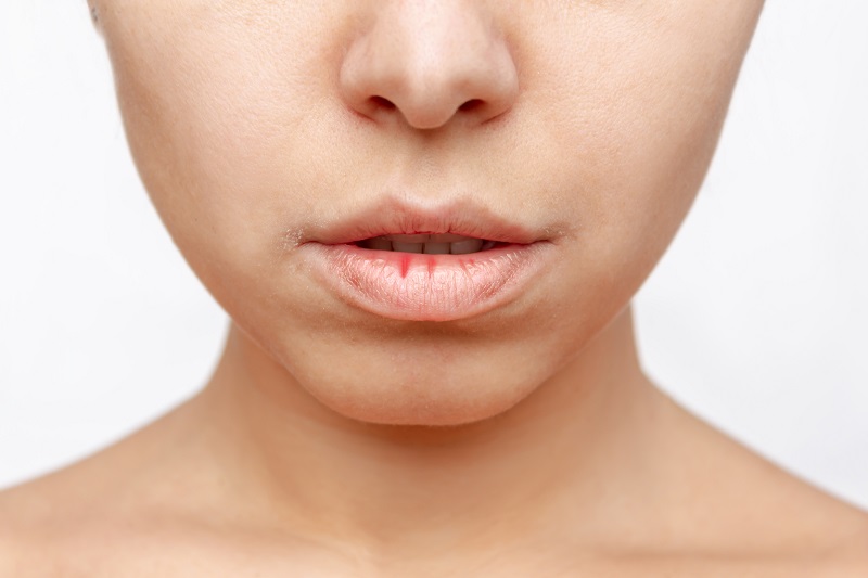gejala dehidrasi bibir kering